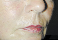 vorher
